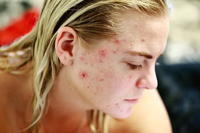 essential oils for acne scars 2