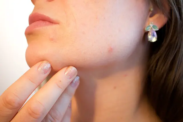 reiki for acne