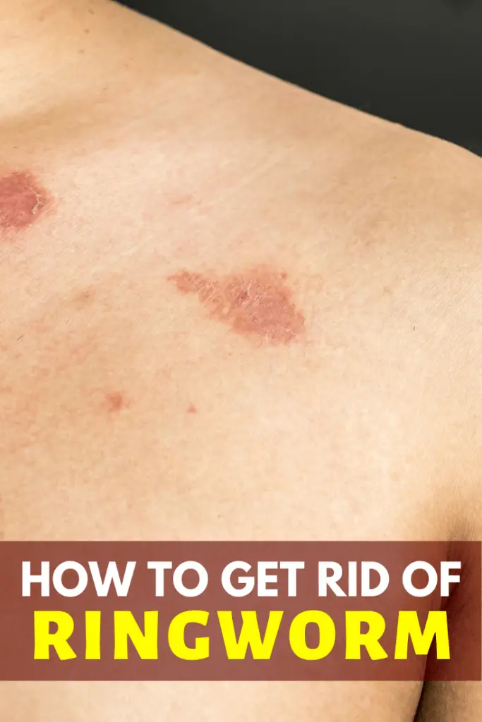 Essential Oils for Ringworm: Naturally Fight Fungus