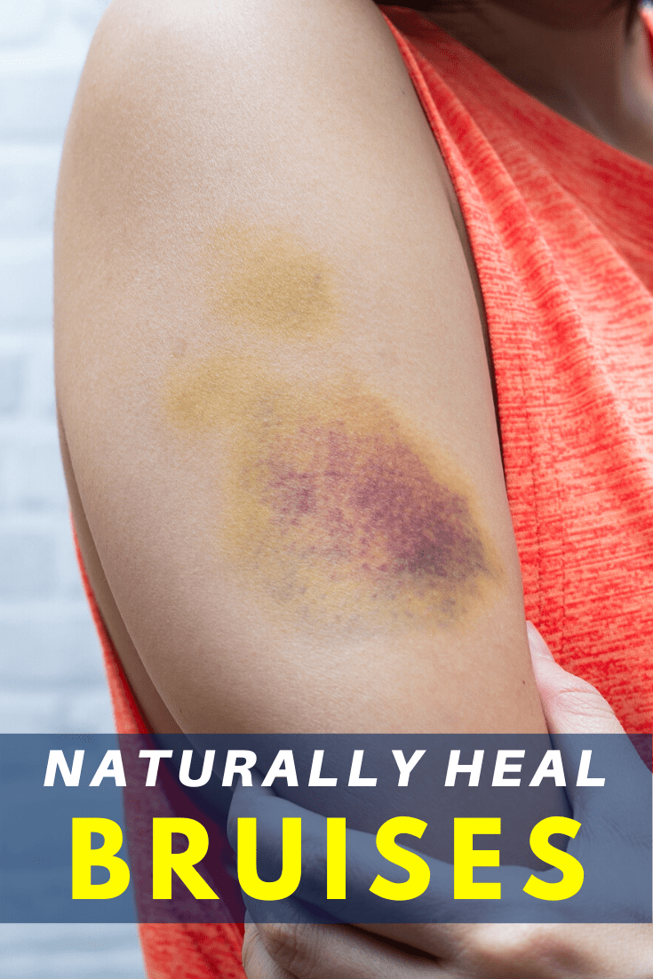 Naturally Heal Bruises