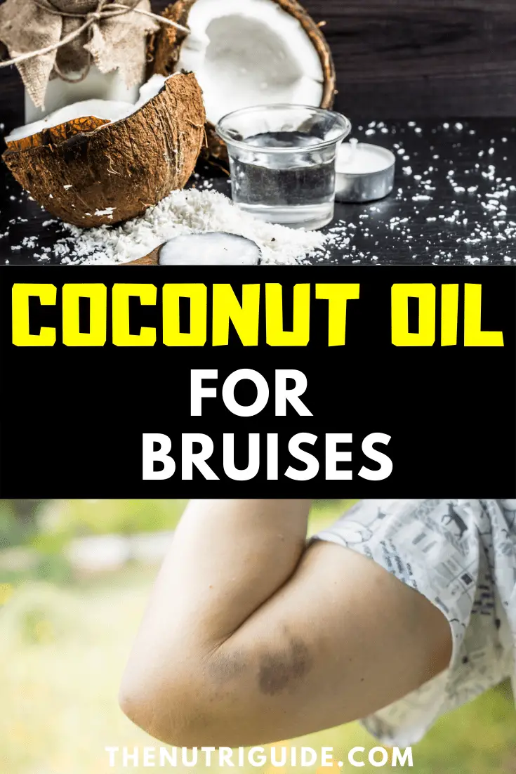 coconut oil for bruises