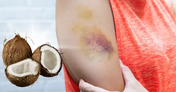 coconut oil for bruises