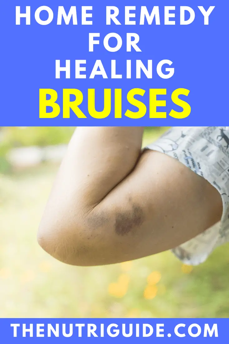 home remedy for healing bruises