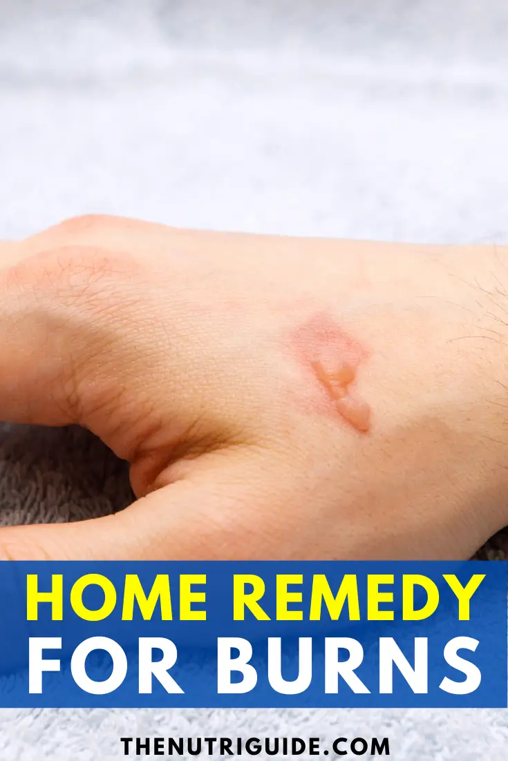 home remedy for burns