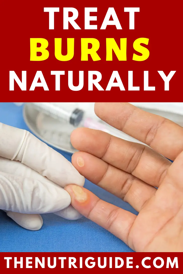 treat burns naturally